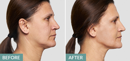 jowl lift - silhouette soft