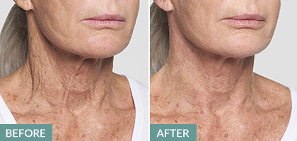 neck lift, thread lift