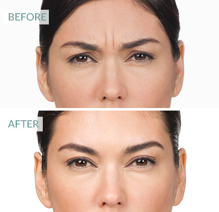 Botox Esher, Surrey, Weybridge anti-wrinkle, wrinkle relaxing injections