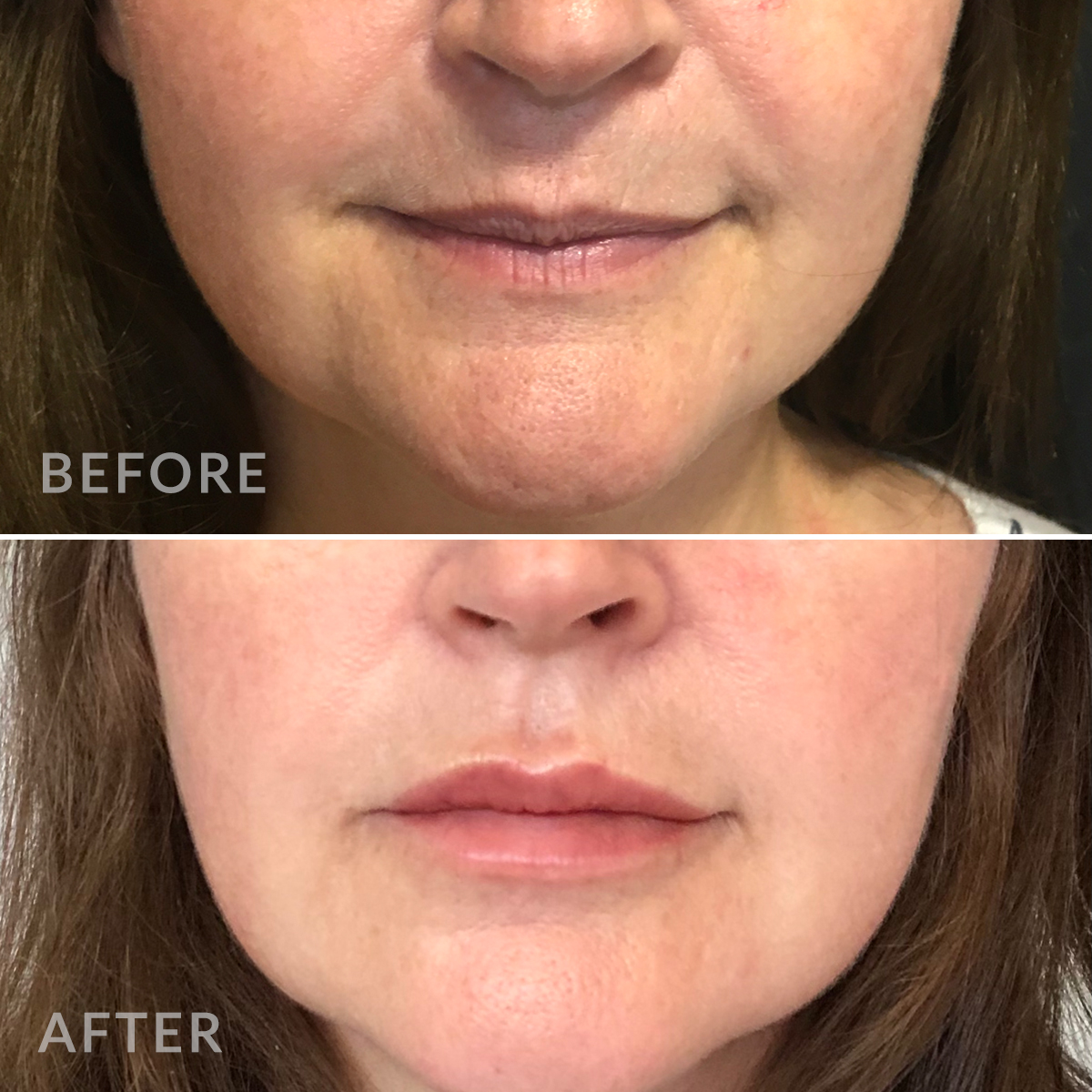 Mouth area rejuvenation - before and after