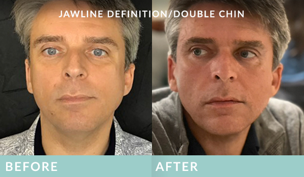 Mens double chin treatment